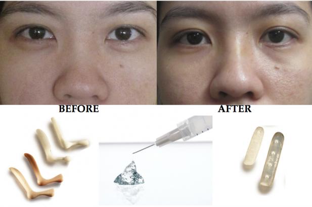 best of Nose surgery implants Asian
