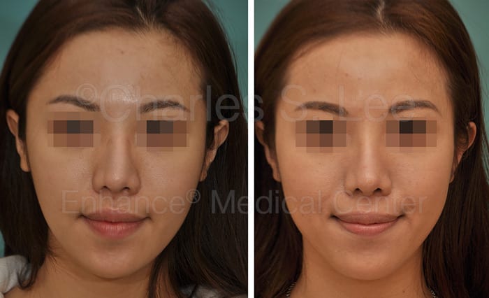 best of Nose surgery implants Asian