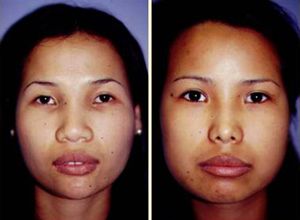 Asian nose surgery implants . Pics and galleries. Comments: 3