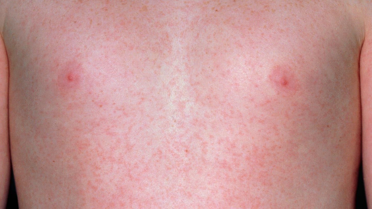 Adult rash over face and chest