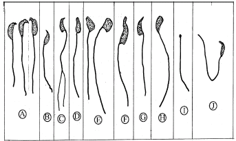 Hemingway reccomend Amorphous morphology of sperm