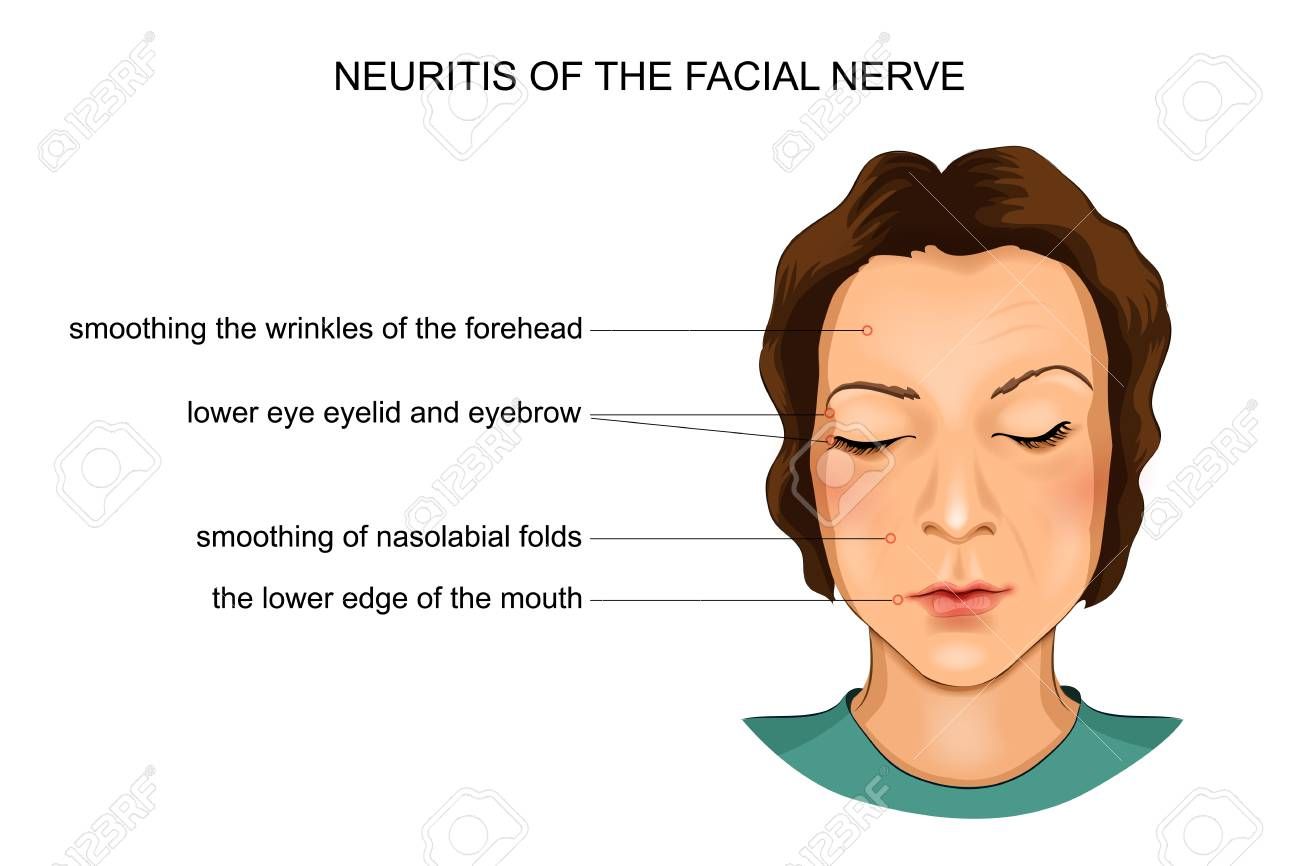 best of Nerve neuritis Facial