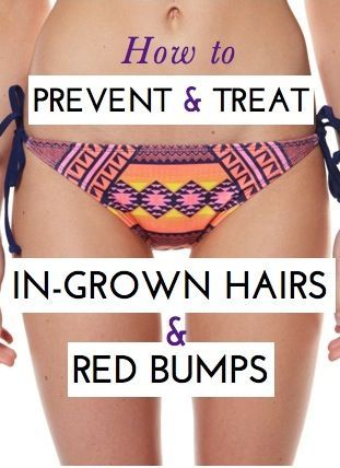 best of Hairs ingrown to How in area prevent bikini