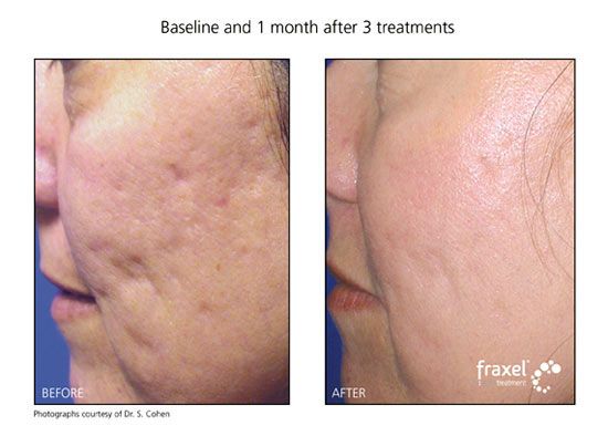 Facial restoration from acne and dark spots