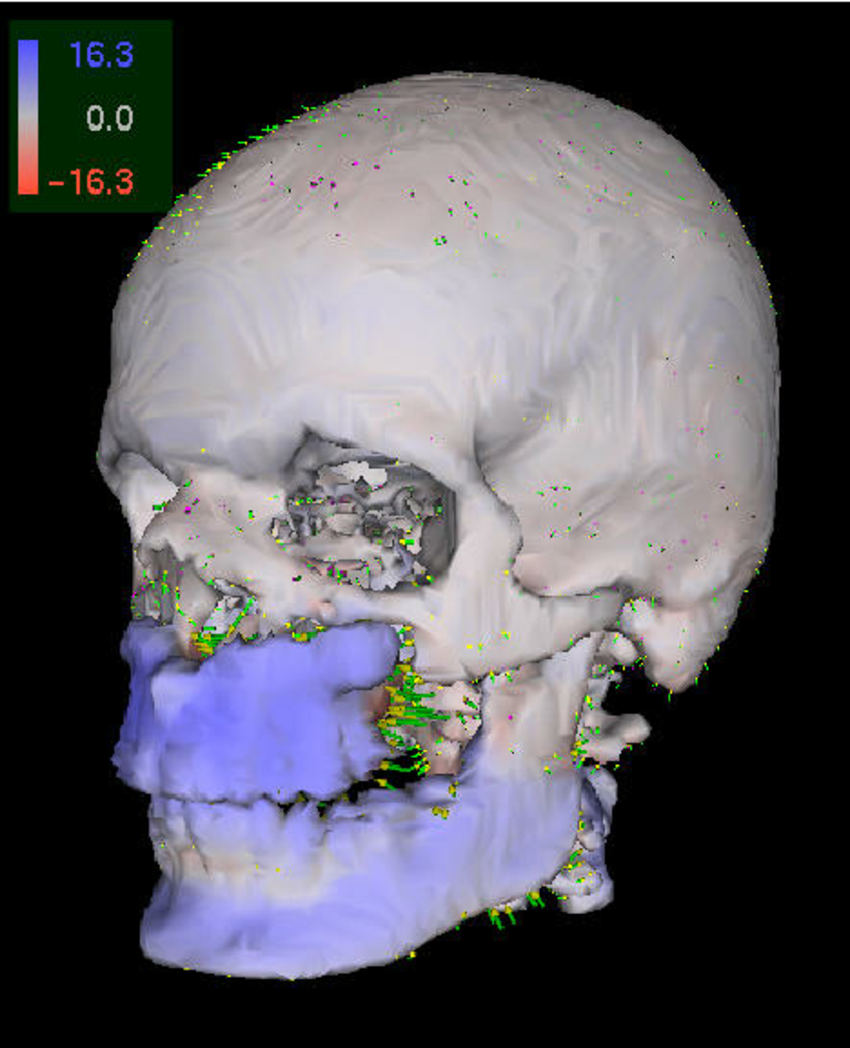 Distraction osteogenesis of the facial skeleton