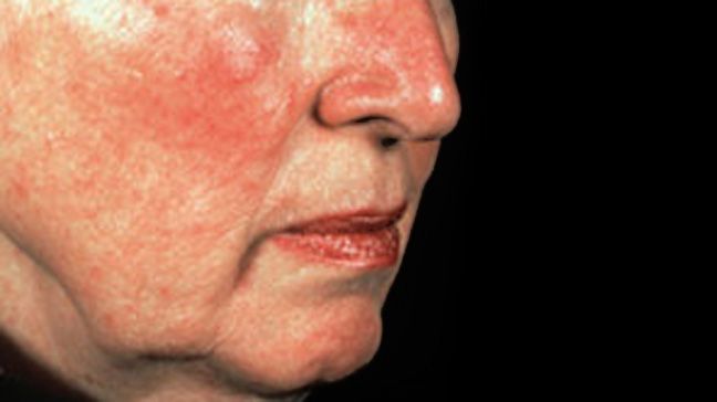 best of Wine rash Can cause facial