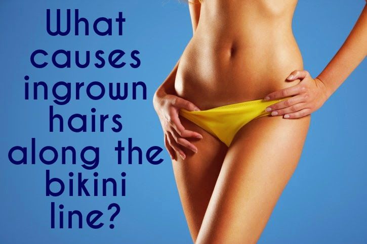 How to prevent ingrown hairs in bikini area
