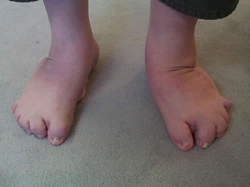 Club foot in adult