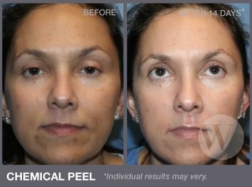 best of Peel recovery Facial