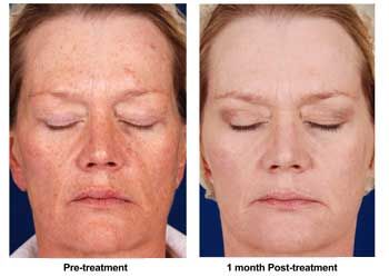 Facial peel recovery