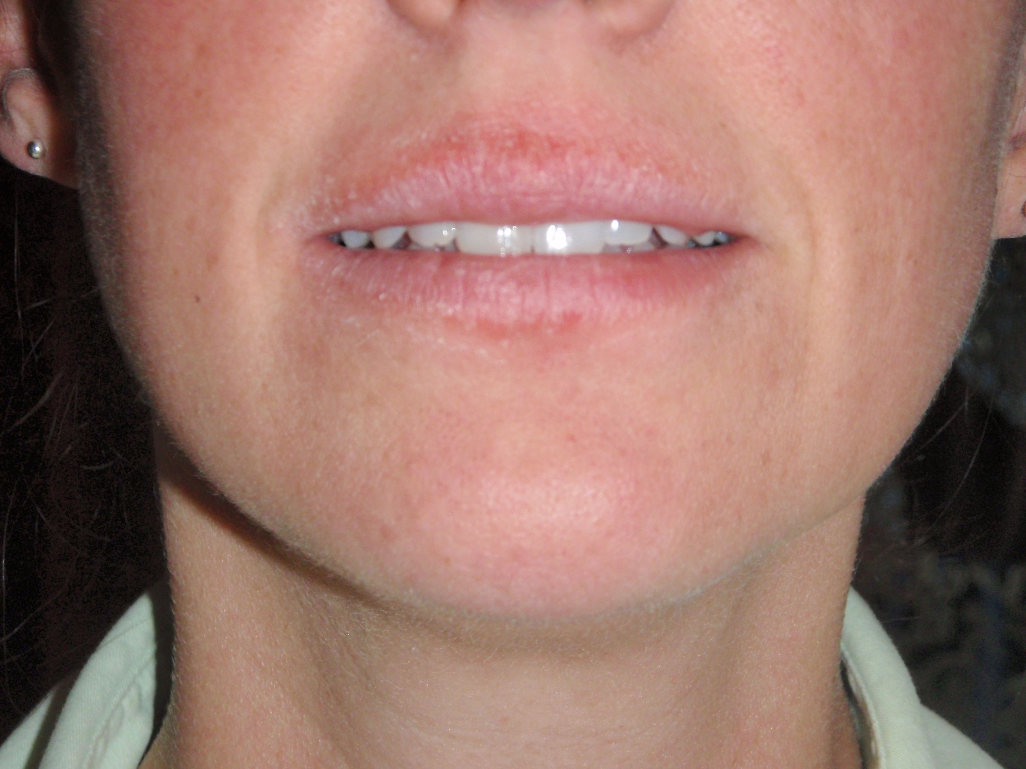 Crystal reccomend Facial red lip blotches