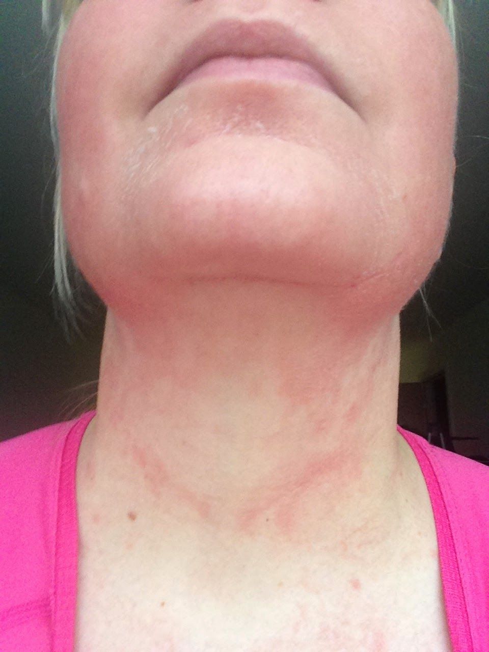 Monster M. reccomend Facial red lip blotches