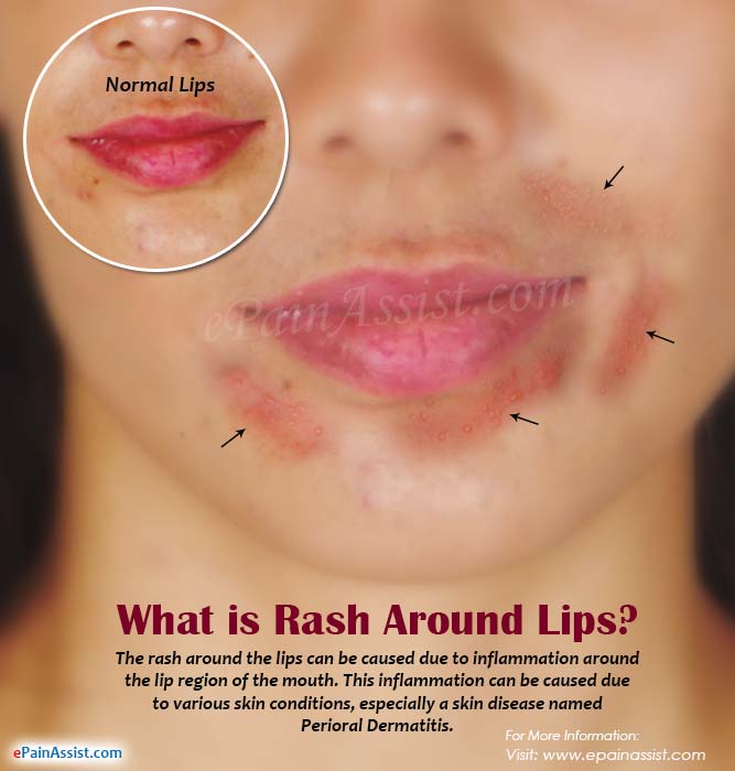 Piston reccomend Facial red lip blotches