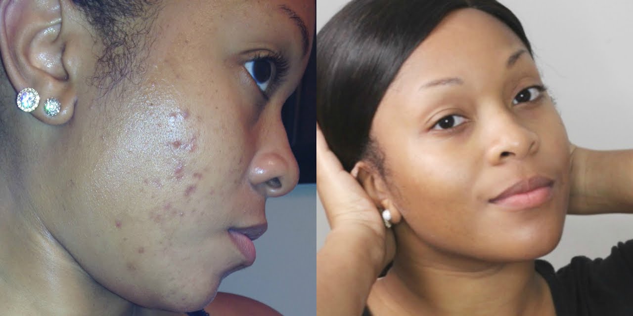 Gem reccomend Facial restoration from acne and dark spots