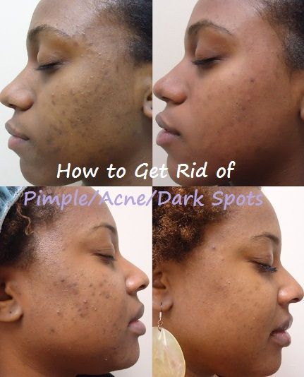 Lunar reccomend Facial restoration from acne and dark spots