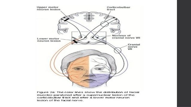 best of Neuron palsy Motor facial