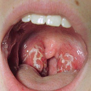 Oral sex throat infection