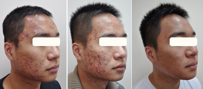 best of Facial scars surgery Plastic