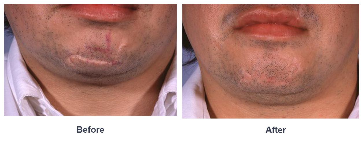 best of Facial scars surgery Plastic