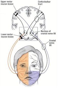 Upper motor neurone facial palsy