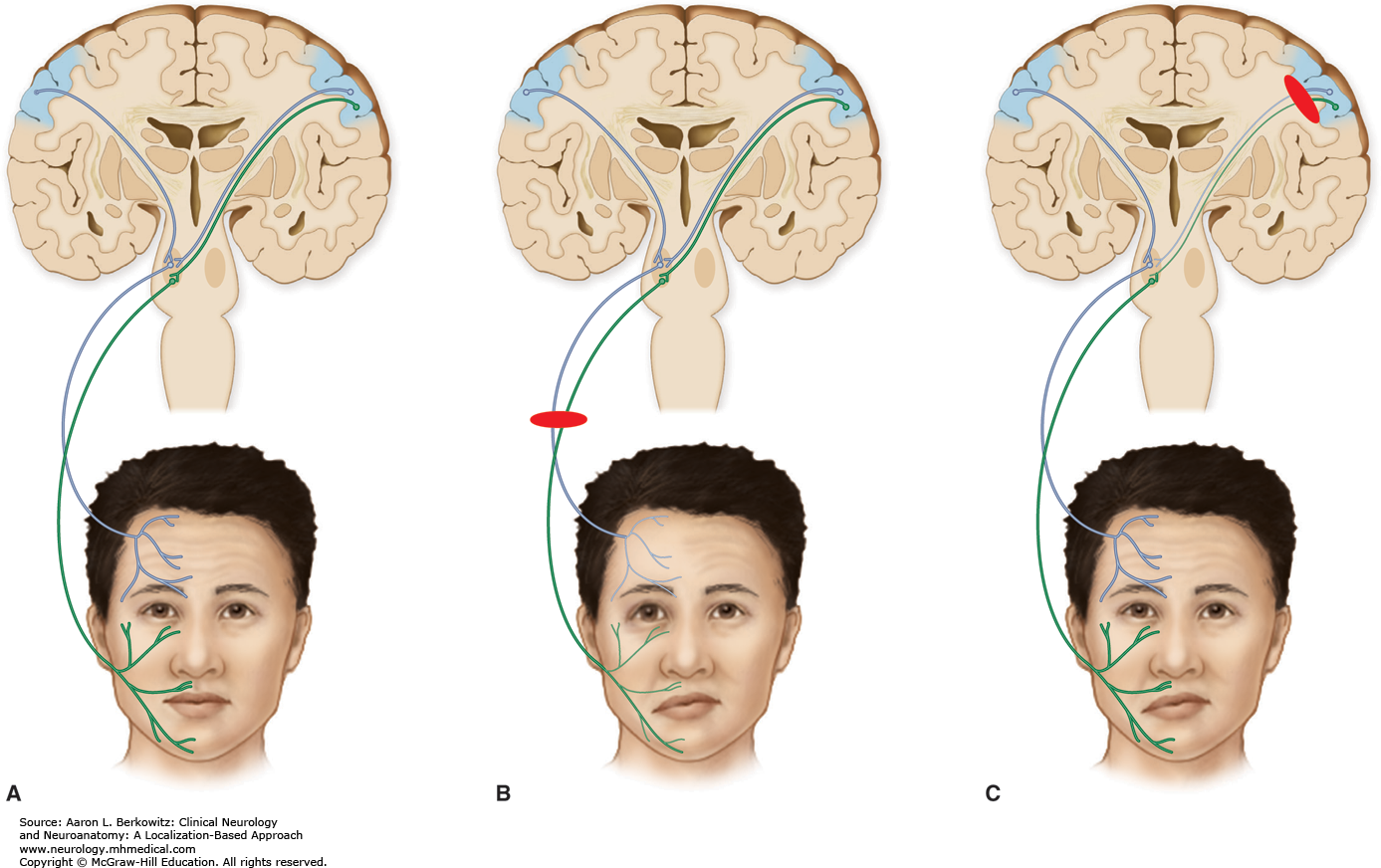 best of Motor neurone palsy Upper facial