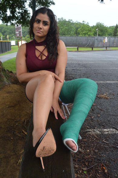 Woman sexy leg cast