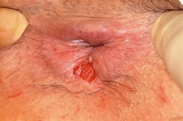Hot B. reccomend Women anal bleeding